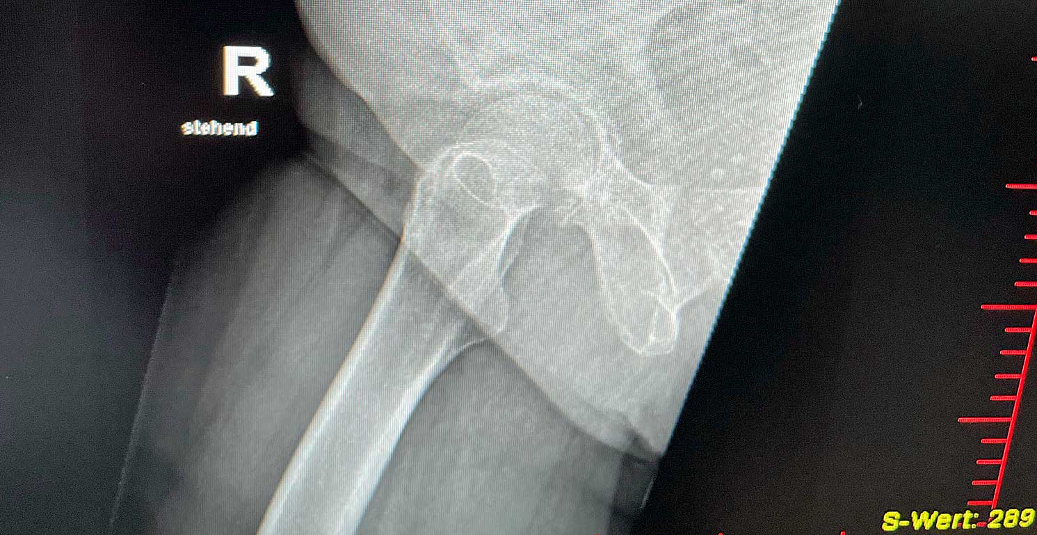 Hüfte-Coxarthrose