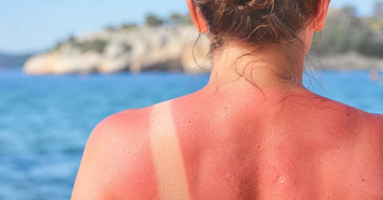 Sommer, Sonne, Sonnenbrand